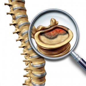 doenças na coluna vertebral