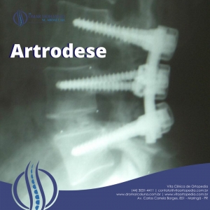 artrodese